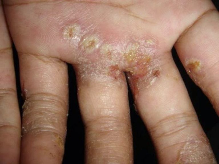 Apa Itu Scabies Berikut Penjelasan Beserta Cara Pengobatannya Yang Ampuh